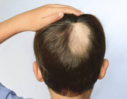 اكتشاف جزيء يساعد في تعزيز نمو الشعر الجديد في مرضى الثعلبة ذكرية الشكل