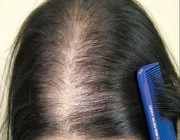 7 أسباب وراء تساقط الشعر عند النساء