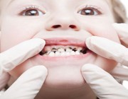 أخصائية: الاهتمام بنظافة لثة الأطفال منذ الرضاعة أمر مهم لتفادي تسوس الأسنان