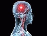 5 علامات تشير إلى الإصابة بالسكتة الدماغية “الصامتة”.. تعرف عليها