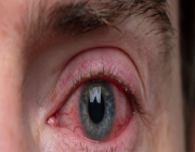 5 أسباب شائعة لاحمرار العين