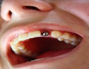 تقنية حديثة لإزالة زراعة الأسنان في حال فشلها بخمس دقائق.. “تفاصيل”