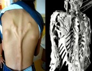 يحول العضلات إلى عظام.. دراسة تكشف أسرار “المرض الغامض”