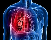 “فهد الطبية” توضح أسباب سرطان الرئة وطرق الوقاية