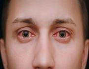“سعود الطبية” توضح أعراض حساسية العين وأسبابها وطرق الوقاية منها