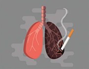 “سعود الطبية”: 4 مسببات لسرطان الرئة بخلاف التدخين
