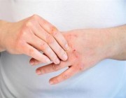 “الصحة” توضح كيفية حماية الجلد من الجفاف والتشققات في الشتاء