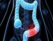 “سعود الطبية”: 6 عوامل تزيد من احتمالية الإصابة بسرطان القولون والمستقيم