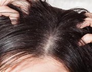 أنواع قشرة الشعر وكيفية الوقاية منها