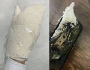 إصابة فتاة بحروق في يدها بسبب اشتعال جوالها الموصول بالشاحن