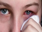 منها زيادة الدموع.. أعراض وأسباب حساسية العين خلال الصيف