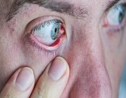 استشاري: أعراض متلازمة جفاف العين تزداد في فصل الصيف وبعض المواسم