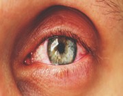 استشاري عيون يحذر  من استخدام القطرات بشكل عشوائي دون وصفات طبية