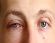 مخاوف من عدوى انتشار التهاب العين الفيروسي .. وطبيب يُحذر