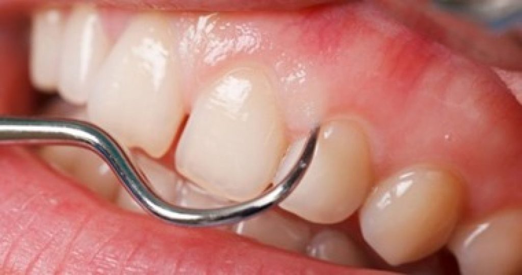 مشاكل صحية مزعجة تسببها «الأسنان المعوجة».. تعرف عليها
