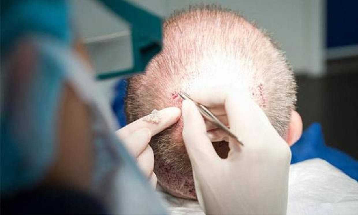 وفاة رجل أعمال أثناء عملية زراعة شعر في عيادة خاصة