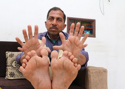 رجل الأصابع .. هندي يحطم الأرقام القياسية بـ 28 أصبع