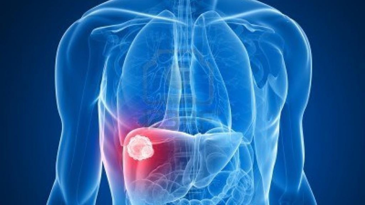 دراسة تربط بين أمراض اللثة وسرطان الكبد