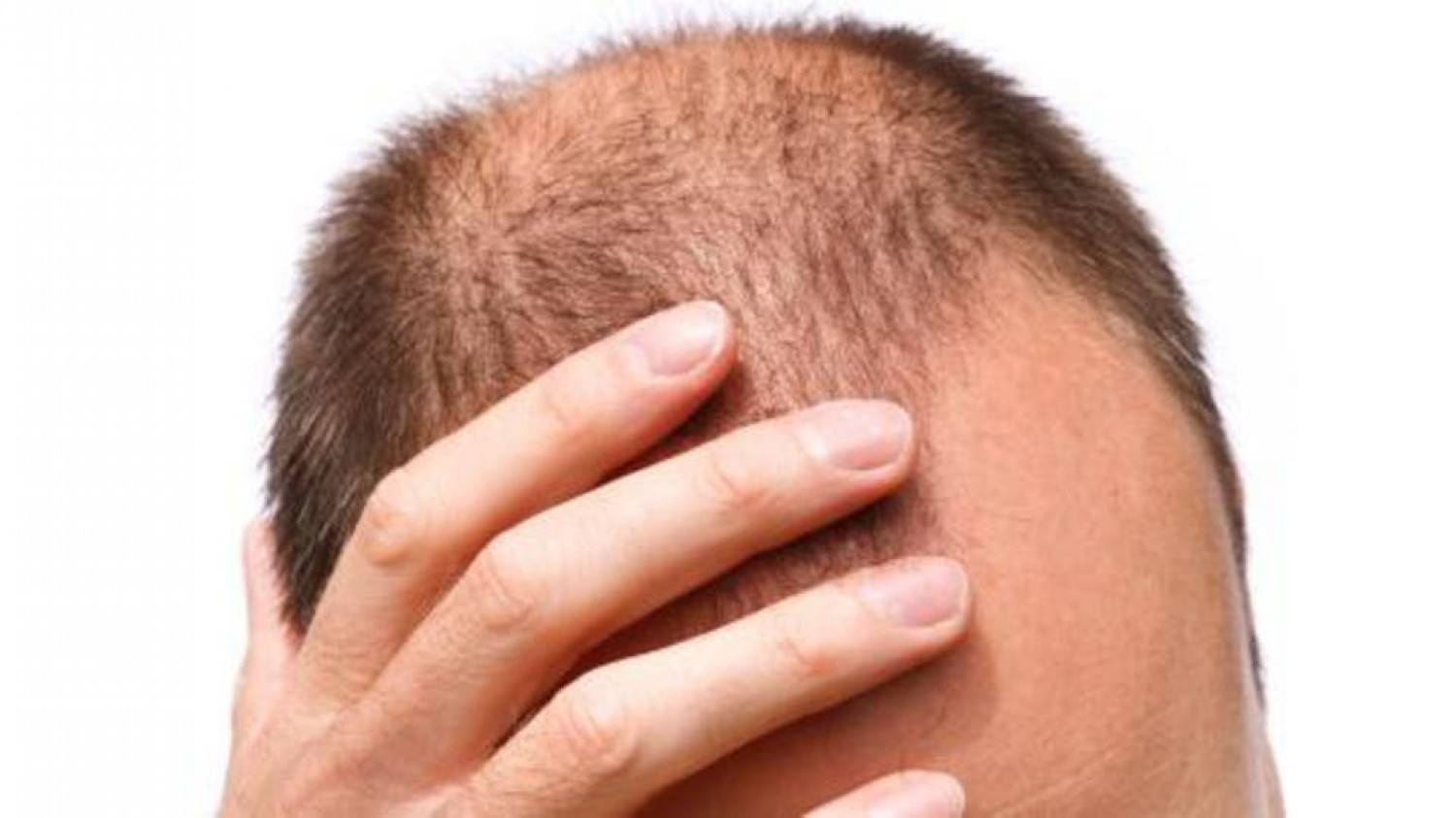 «توليد الشعر» علاج جديد ونهائي للصلع.. يصلح لجميع الحالات
