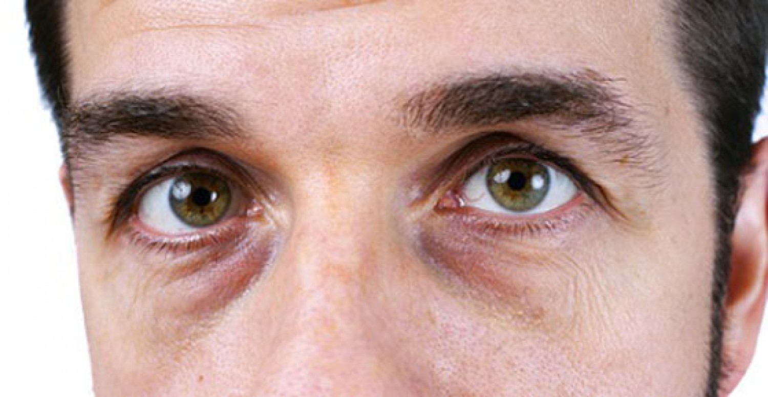 5 طرق لإزالة الانتفاخات تحت العيون