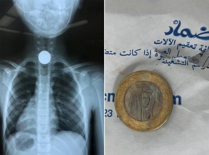 إنقاذ طفل بعد ابتلاعه قطعة معدنية في محافظة المويه