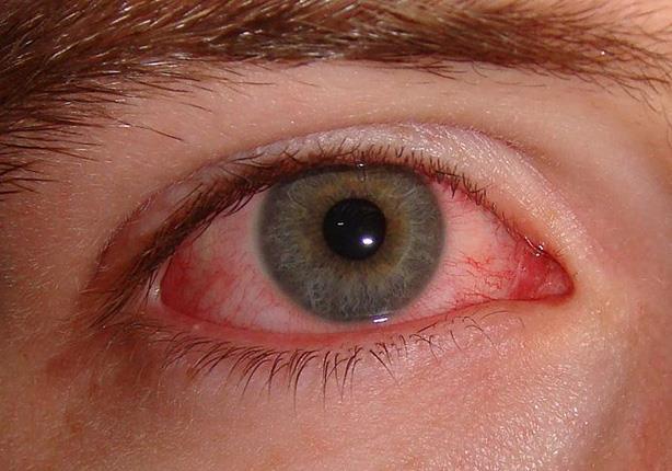 استشاري يوضح أسباب ارتفاع معدلات الإصابة بـ”جفاف العين” (فيديو)