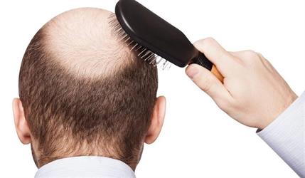 ما هو المعدل الطبيعي لتساقط الشعر يومياً وما علاجه؟.. استشارية جلدية تجيب