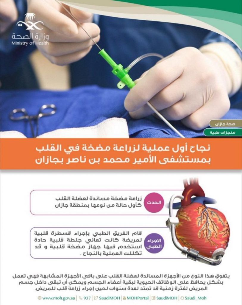 جازان.. نجاح أول عملية لزراعة مضخة قلب في مستشفى الأمير محمد بن ناصر
