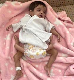 شاهد.. بدء عملية فصل التوأم الطفيلي اليمني "عائشة".. ووالدها يعلق