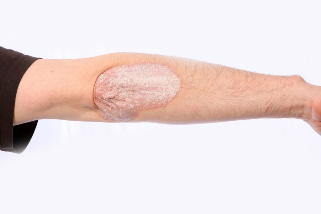 طبيبة: تشقق جلد المرفقين قد يكون مؤشرًا للإصابة بحالات مرضية