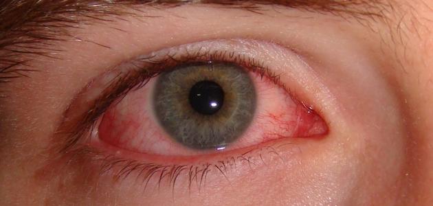 ما هي أسباب احمرار العين بشكل مفاجئ؟