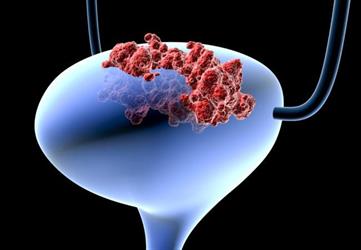 “الصحة” توضح كيف ينتشر سرطان المثانة وماهي عوامل خطورته وطرق العلاج