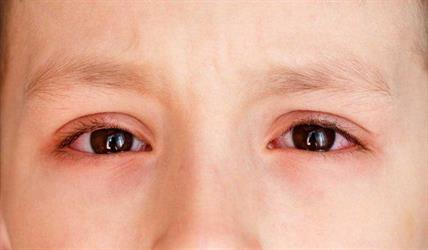 احمرار العيون عند الأطفال.. أبرز الأسباب والأعراض وطرق العلاج