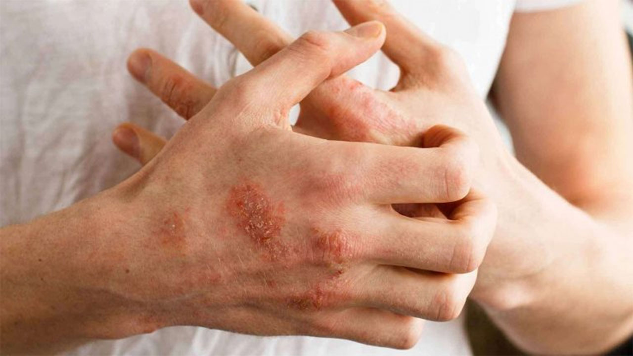 قواعد اساسية لحماية الجلد من حساسية الشتاء.. تعرف عليها