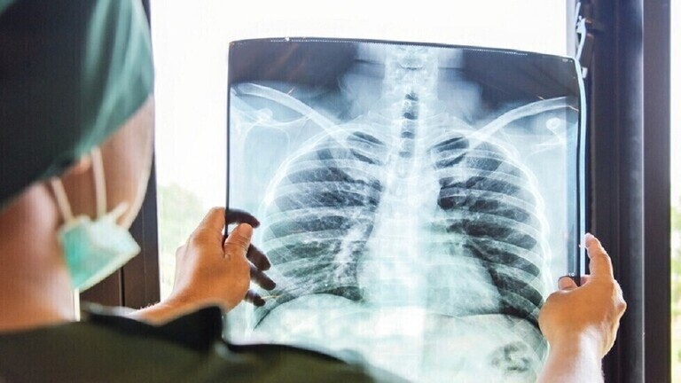 صور “صادمة” بالأشعة السينية تكشف عن آثار تلف الرئة في مرضى كورونا غير الملقحين