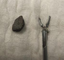 مستشفى الملك خالد بتبوك ينجح في إزالة قطعة حجرية من صدر طفل