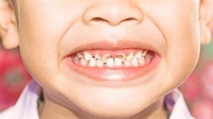 " الصحة": 9 أسباب لتسوس الأسنان و3 إرشادات لتخفيف آثارها
