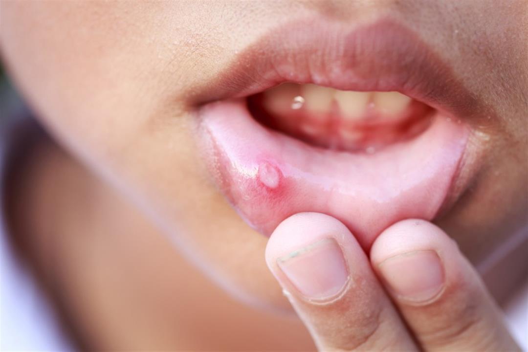 4 علامات تحذيرية لسرطان الفم