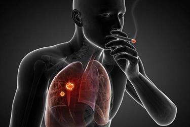 استشاري: التدخين المسبب الأول للسرطان بنسبة 33%