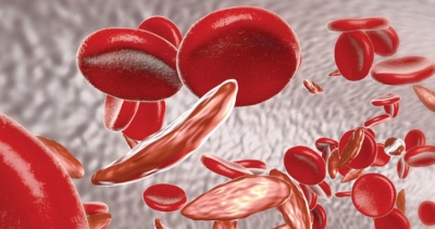 اعتماد أول علاج "جيني" لفقر الدم المنجلي