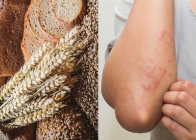 'دواء' للربو يقي من 'الحساسية' الغذائية