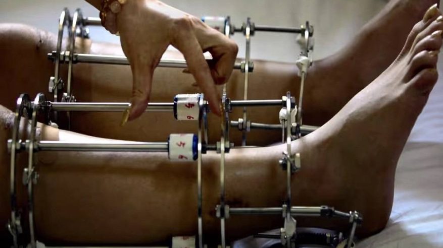 وفاة مواطن سعودي بعد عملية لإطالة القامة في تركيا