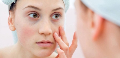 الذئبة الحمراء.. هجوم مناعي تكافحه 4 إرشادات