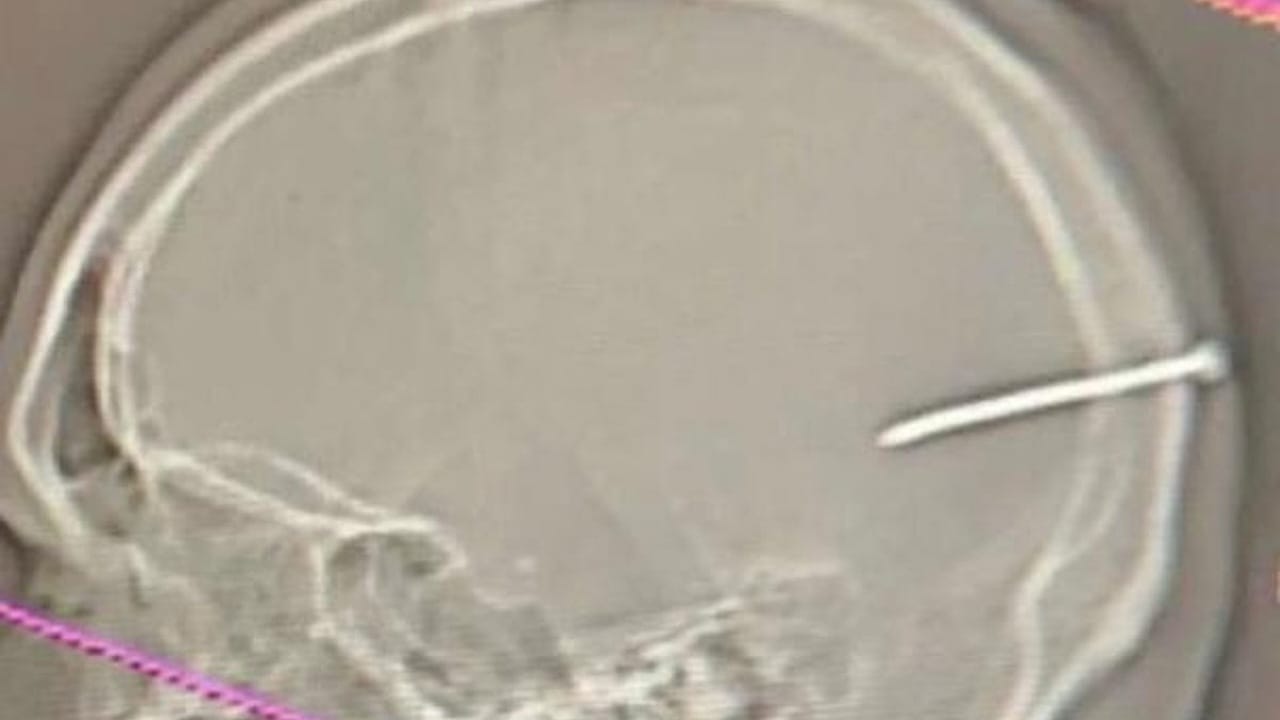 بطول 8 سم .. استخراج “مسمار” من جمجمة مقيم بمستشفى ينبع